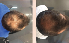 Regenerar la caida del cabello